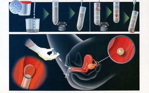 Learn about intrauterine insemination (IUI) technique at Vinmec