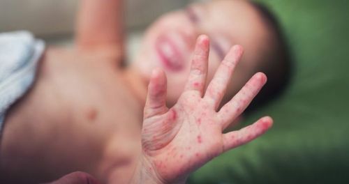 Hand - Foot - Mouth Disease in children: how to recognize and prevent