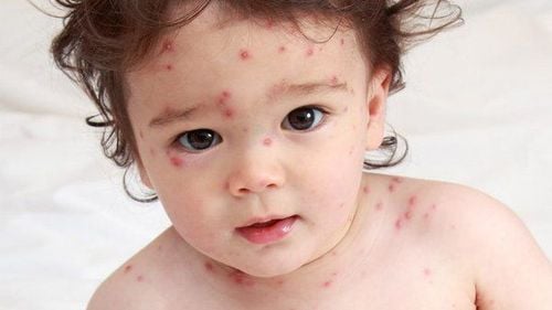 Care for children with chickenpox properly to avoid dangerous complications