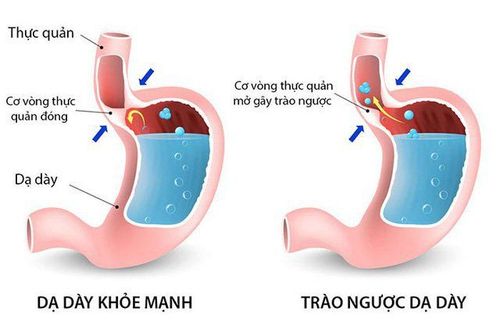 
Trào ngược dạ dày là do cơ vòng thực quản trên không đóng kín.
