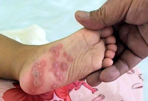 What to abstain when your child has hand, foot and mouth disease?