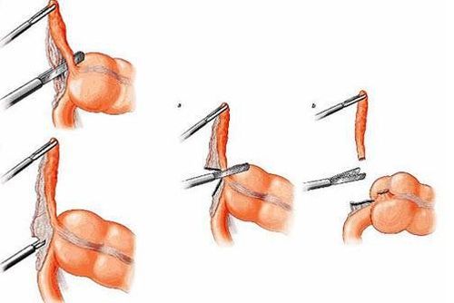 
Nguyên tắc điều trị viêm ruột thừa cấp là phẫu thuật cắt bỏ ruột thừa
