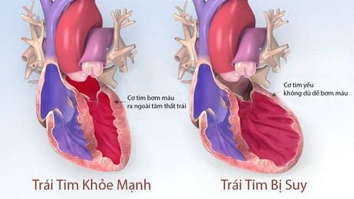 
Suy tim ngày càng gia tăng, nhưng còn ít người biết
