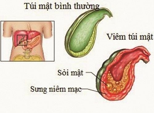 Is gallstone dangerous?