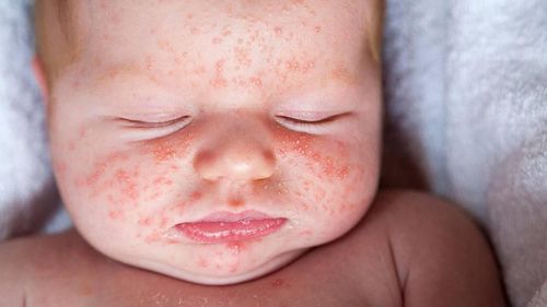 Join Vinmec International General Hospital to learn about measles