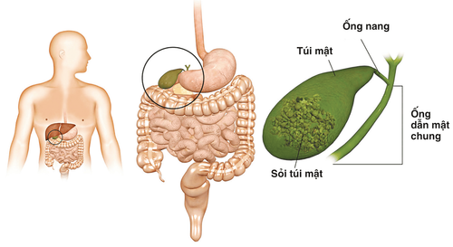 Sỏi mật có nguy hiểm không thưa bác sĩ?