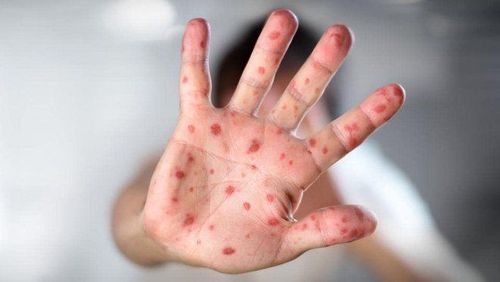 Signs to recognize and prevent measles during the epidemic season