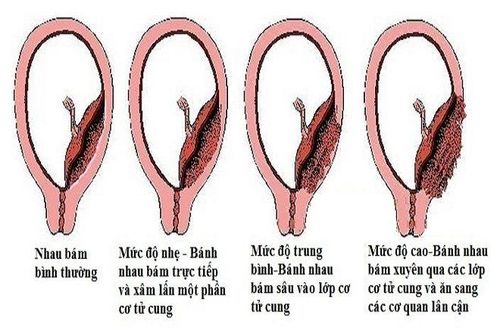 Siêu âm có phát hiện sớm được rau cài răng lược không?