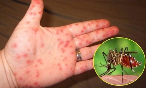 How are the symptoms of dengue fever similar and different from typhus?