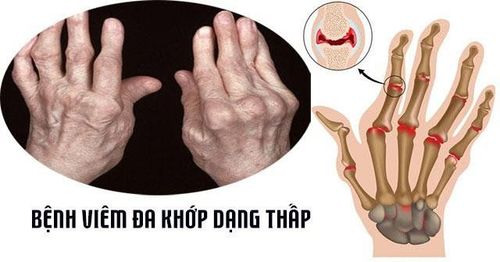 
Các ngón tay có hình thoi trong bệnh lý viêm đa khớp dạng thấp
