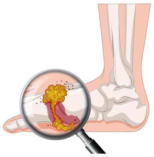 
Tinh thể urat trong dịch khớp của bệnh Gout
