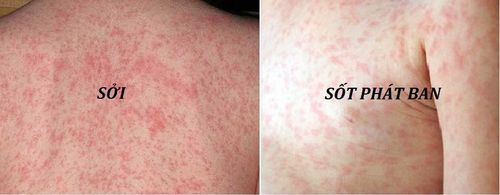 Distinguish the signs of typhus from measles