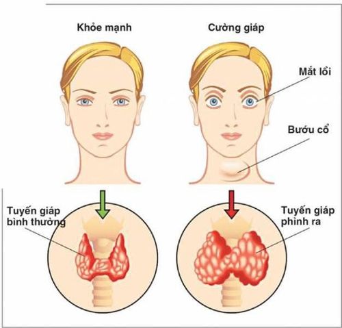 Is hyperthyroidism dangerous?