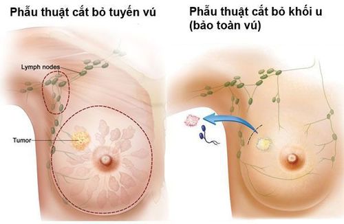 
Phẫu thuật bảo tồn vú với mục tiêu lấy bỏ hoàn toàn mô ung thư vú và để lại tối đa mô bình thường xung quanh.
