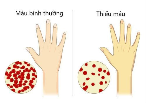 Nhận biết và dự phòng thiếu máu dinh dưỡng