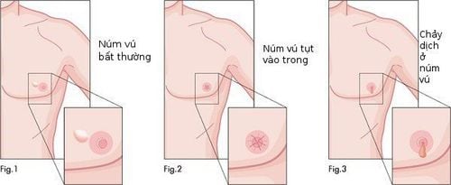 
Dấu hiệu ung thư vú ở nam giới
