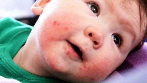 Hand, foot and mouth disease in children continues to develop complicatedly in the southern provinces