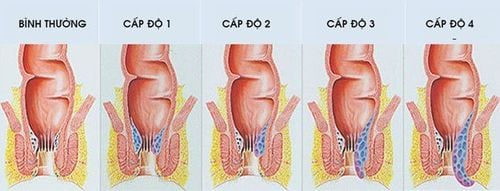 
Các cấp độ thường gặp ở bệnh trĩ
