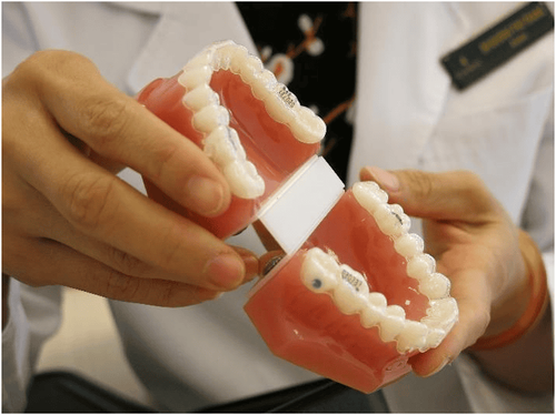 
Khay Invisalign trong suốt là lựa chọn phổ biến của dân công sở khi niềng răng
