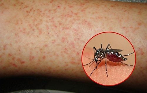 Dengue fever in Hanoi is likely to break out in late March and early April