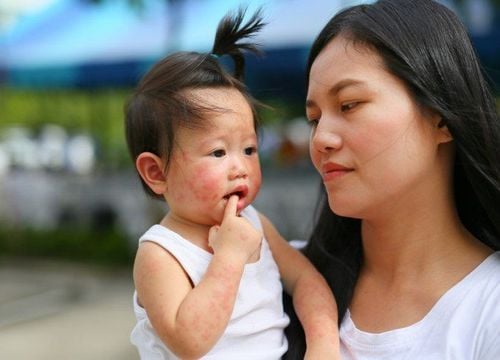 Is hand, foot and mouth disease contagious? By which way?