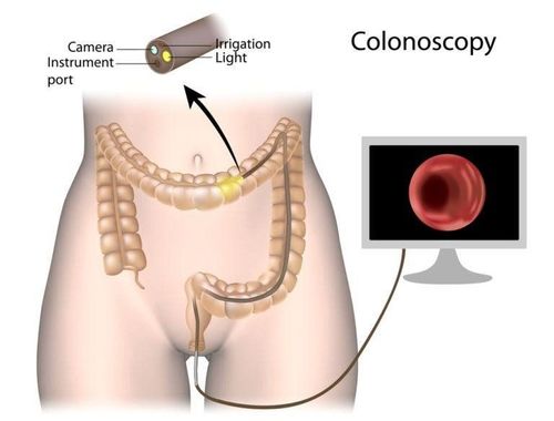 Factors affecting the effectiveness of colorectal cancer screening in population groups during the Covid-19 epidemic