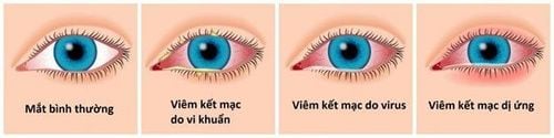 
Nguyên nhân gây bệnh bao gồm do virus, do vi khuẩn và do tác nhân gây dị ứng.
