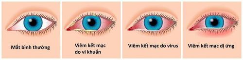 
Viêm kết mạc thường do nhiều nguyên nhân dẫn tới mức độ ảnh hưởng khác nhau
