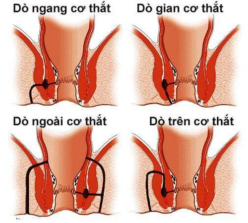 
Phân loại bệnh rò hậu môn để lựa chọn phương pháp điều trị được thuận tiện
