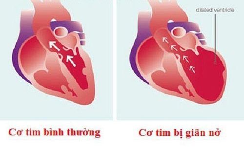 
So sánh cơ tim bình thường và cơ tim bị giãn nở.
