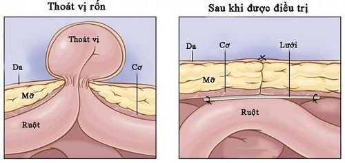 
Đối với trẻ em, các biến chứng của thoát vị rốn là rất hiếm.
