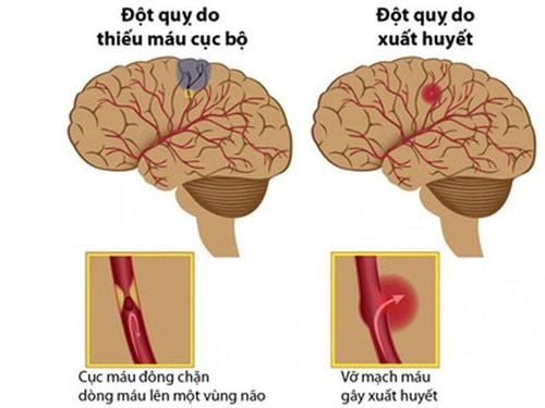 
Tai biến mạch máu não ( đột quỵ não) được chia làm hai loại chính là nhồi máu não và xuất huyết não.
