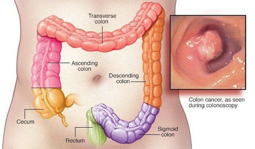 Robotic surgery for colorectal cancer: High efficiency, much pain relief