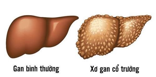 
Sự khác biệt của gan bình thường và xơ gan cổ trướng.
