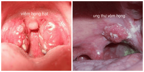 Difference between nasopharyngeal cancer and common pharyngitis