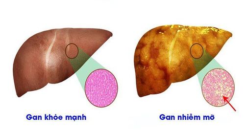 What is grade 1 fatty liver?