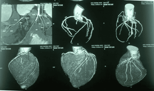 Percutaneous coronary angiography at Vinmec International General Hospital