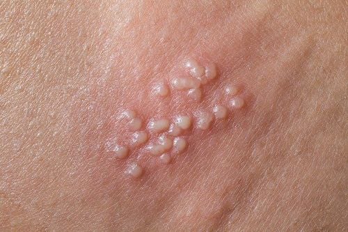 
Đám mụn nước nhỏ, cụm lại như chùm nho là đặc điểm của vết loét do herpes giai đoạn đầu
