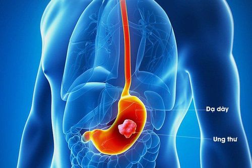 12 causes of stomach cancer are warned by experts