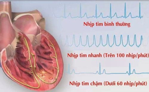 
Rối loạn nhịp tim là căn bệnh tim phổ biến xảy ra
