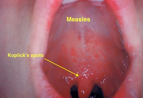 
Đặc trưng bệnh sởi là phát ban đỏ trên da và các hạt Kop lick trong miệng
