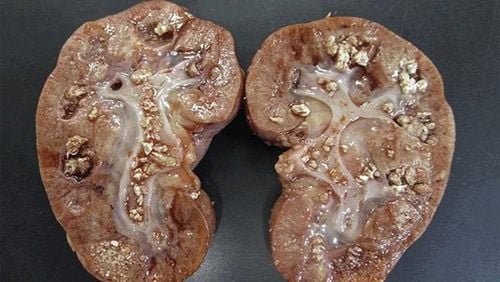 What you need to know about kidney stones