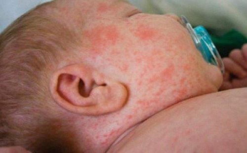 Virus Sốt: Những Điều Cần Biết và Cách Phòng Ngừa Hiệu Quả