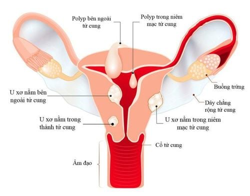 Uterine fibroids appear in many locations.