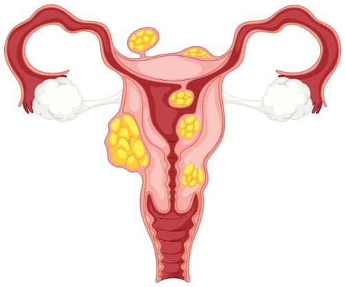 Treatment of uterine fibroids is based on the size and location of the tumor.