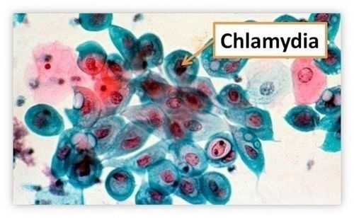 
Vi khuẩn nội bào Chlamydia trachomatis
