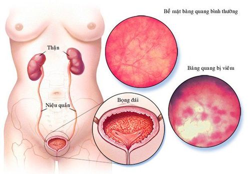 Is acute cystitis dangerous?