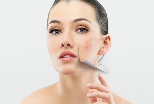 Foods that are not good for acne skin