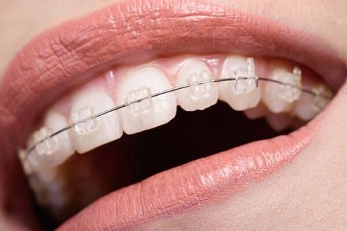 
Mắc cài thẩm mỹ (mắc cài sứ, composite) trở thành chọn lựa càng ngày càng phổ biến hơn
