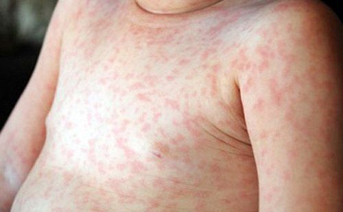 
Ổ chứa virus gây bệnh Rubella duy nhất là ở người.
